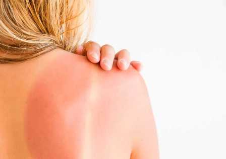 Защита кожи от солнечных ожогов: советы и рекомендации врачей